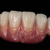 Composit crown