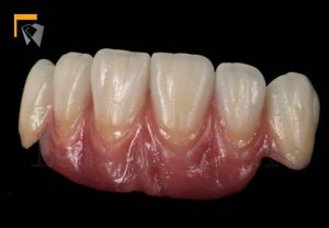 Composit crown